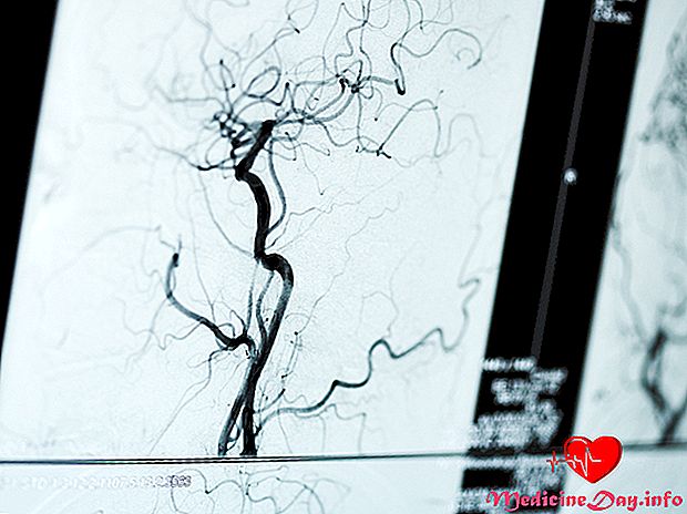 Arteriogram