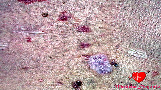 Basalcell Nevus syndrom