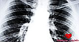 Razumijevanje kroničnog bronhitisa