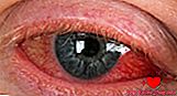 Tørt øjesyndrom