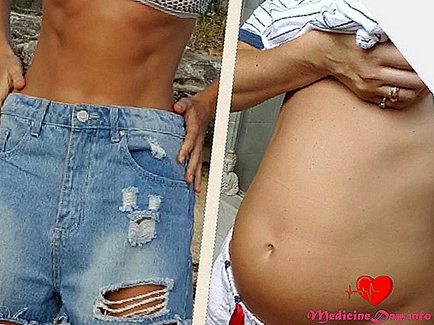 Ten model na Instagramie jest prawdziwy o jej IBS - i o tym, jak sobie z tym radzi