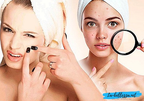 Cómo deshacerse del acné en la cara en casa rápidamente en 1 día