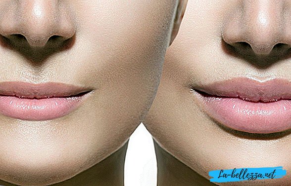הגדלת שפתיים: מה יקרה לאחר ההליך?