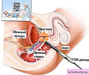 Adénome de la prostate - causes, symptômes, diagnostic, traitement
