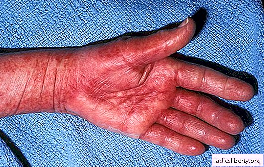 Amyloidosis - what it is: causes, symptoms and treatment. The first signs of amyloidosis, which organs it can affect