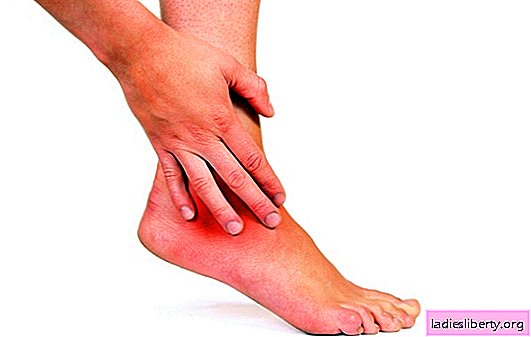 Inflamación articular del pie: causas y síntomas. Métodos para tratar la inflamación de la articulación del pie, consejo del médico.