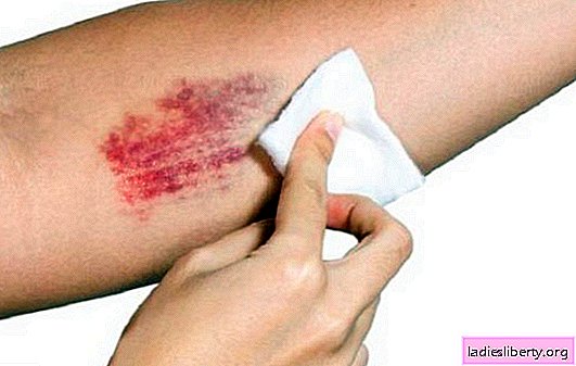 How to treat and mask bruises. Review of the best remedies for bruises: TOP -6