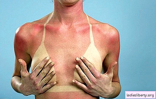 Was tun bei Sonnenbrand: Erste Hilfe für einen Erwachsenen und ein Kind. Wie behandelt man nach dem Bräunen schmerzende Haut?