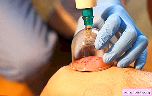 What is hijama and what is it for? Hijama harm: contraindications to the procedure
