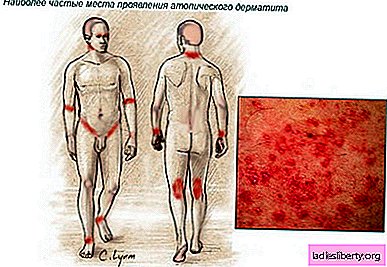 Dermatitis - causes, symptoms, diagnosis, treatment