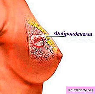 Fibroadenoma: causas, síntomas, diagnóstico, tratamiento.