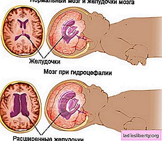 Hidrocefalia: causas, síntomas, diagnóstico, tratamiento.