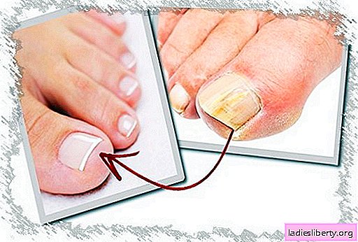 Hongo de la uña del pie - que tratar. Por alguna razón, hay un hongo en las uñas en las piernas y qué medios son efectivos en el hogar.
