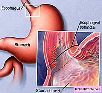 Acidez estomacal: causas, síntomas, diagnóstico, tratamiento
