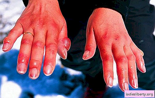 How to provide first aid for frostbite. Degrees of frostbite, first aid, treatment of consequences of frostbite of limbs