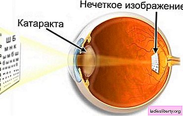 Cataracte - causes, symptômes, diagnostic, traitement