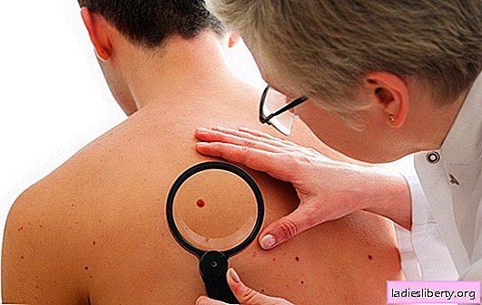 When it is necessary to get rid of moles: causes and types of these neoplasms. Safe Moles