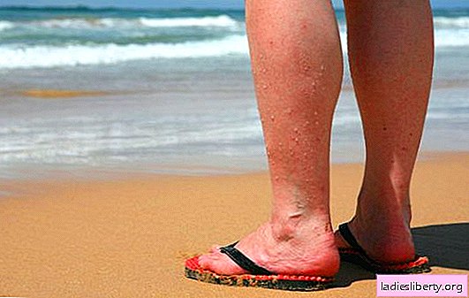 When does varicose veins become a mortal danger in women?