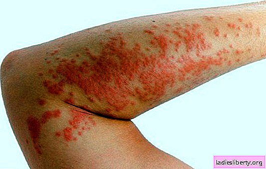 Urticaria: how to treat at home? Topical methods of treating urticaria at home