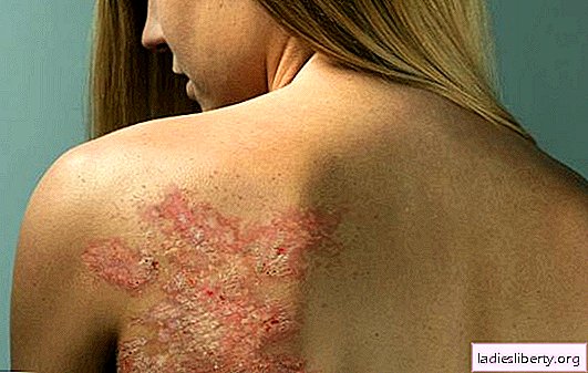 Psoriasis treatment at home. Is it possible to get rid of psoriasis by folk methods?
