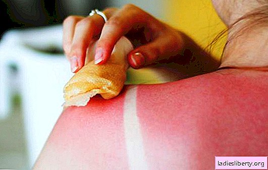 Sunburn treatment at home. How to provide first aid for sunburn at home?