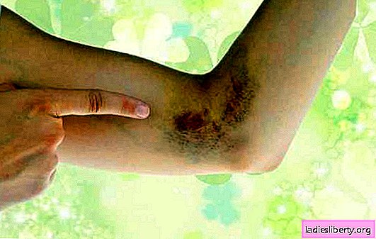 Treatment of bruises at home - first aid and subsequent therapy. How to treat a bruise with medicines and folk remedies