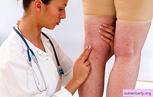 Treatment of varicose veins with folk remedies at home: effective or dangerous? Doctor's opinion on traditional medicine against varicose veins