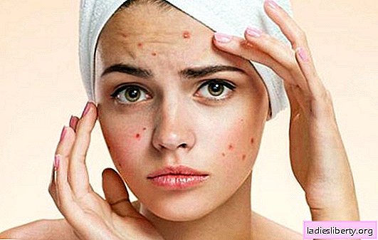 Puis-je me débarrasser de l'acné avec un traitement à domicile? Meilleurs traitements contre l'acné à la maison