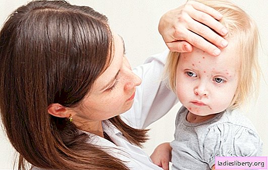 Is it possible to get chickenpox a second time: risk factors. How can I get chickenpox a second time and what to do