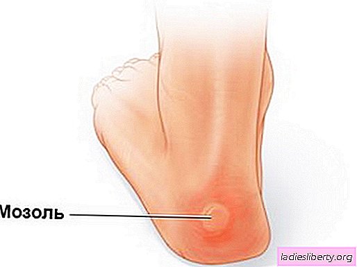 Corns on the legs (on the toe, heel, sole) - what to do. For what reason do calluses appear on the feet and how to get rid of them quickly at home?