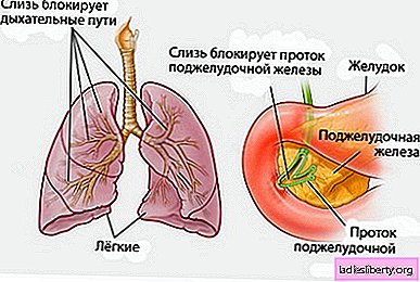 Cystische fibrose - oorzaken, symptomen, diagnose, behandeling