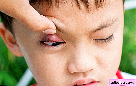 العلاجات الشعبية للشعير. هل البصق في العين فعال حقًا؟