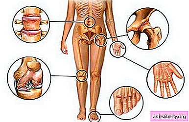 Osteoartrosis: causas, síntomas, diagnóstico, tratamiento.