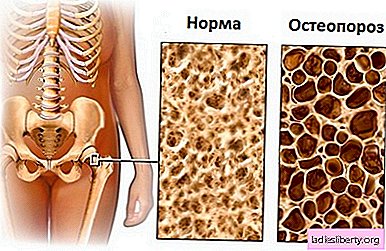 Osteoporose - oorzaken, symptomen, diagnose, behandeling