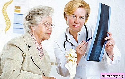 هشاشة العظام لدى النساء: الأسباب والأعراض والتكهن المحتمل والمضاعفات. طرق علاج هشاشة العظام لدى النساء