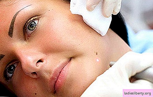 Papilomas en la cara: causas de patología. Papilomas en la cara: cómo deshacerse de la infección por el virus del papiloma