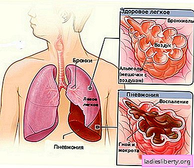 Pneumonia - causes, symptoms, diagnosis, treatment