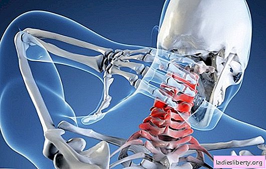 ¿Por qué ocurren las hernias de la columna cervical, por qué son peligrosas? Cómo tratar una hernia de la columna cervical, prevención del dolor