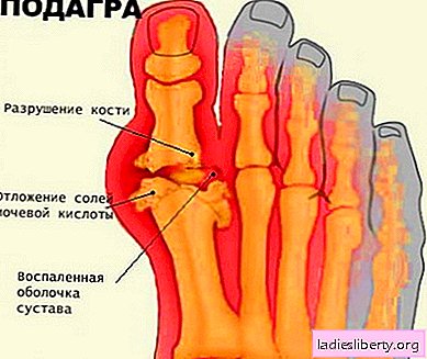 Gout - causes, symptoms, diagnosis, treatment