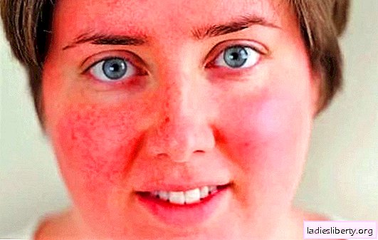 Vermelhidão no rosto: quais são as causas da irritação da pele. Como remover vermelhidão facial: métodos caseiros simples