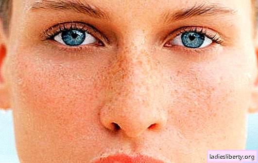 Causes of age spots on the face after childbirth. How to get rid of age spots on the face after childbirth: the most effective ways