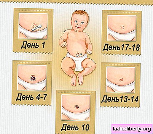 Navel in a newborn - how to treat the umbilical wound in the first weeks from the moment of the baby's birth. What to do if the navel in a child is bleeding or wet.