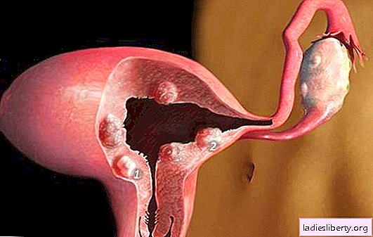 Uterusmyomen Rezepte: Behandlung von Volksheilmitteln. Was ist gefährlich bei der Behandlung von Uterusmyomen mit Volksheilmitteln?