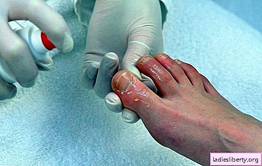 Classement des meilleurs remèdes contre les champignons des ongles des pieds. Quel remède convient le mieux et que peut-on faire pendant la grossesse?