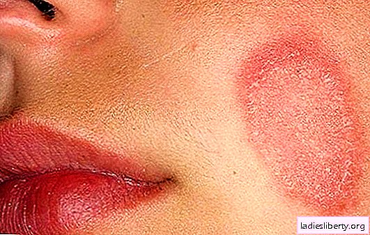 Lichen rose chez l'homme - premiers symptômes, premiers secours. Causes, traitement et prévention du lichen rose chez l'homme