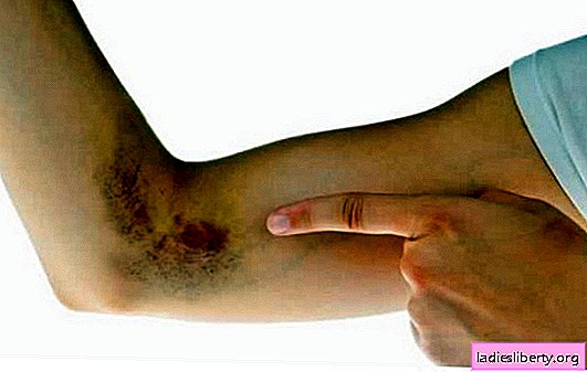 A bruise on the arm is a common thing or a dangerous hematoma. Why do bruises appear on my arm and what to do with them?