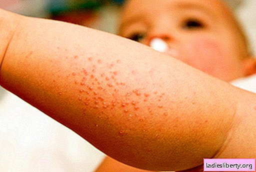 A baby's rash - on the face, stomach, back, face, arms or legs - which means. What are the types of rashes in children and how to treat.