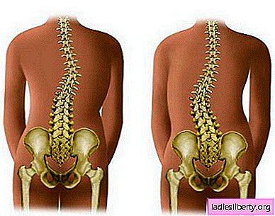 脊柱側osis症-原因、症状、診断、治療