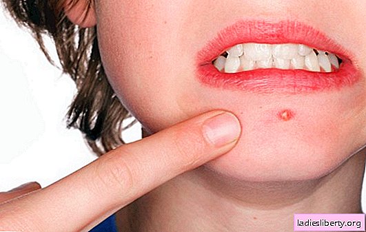 Acnee pe fata: tratament la domiciliu sau la estetician. Ce rețete sunt eficiente pentru tratarea acneei pe față acasă?