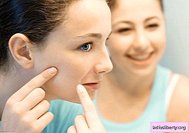 Acne - causes, symptoms, diagnosis, treatment